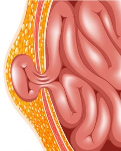 diagram of hernia