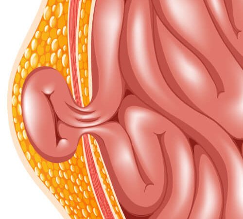 diagram of hernia