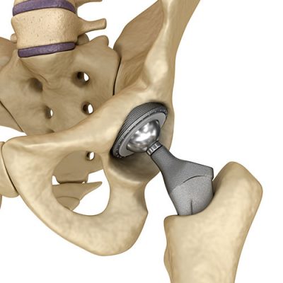 Hip Replacement